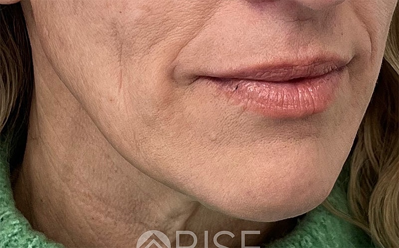 Sculptra Before & After