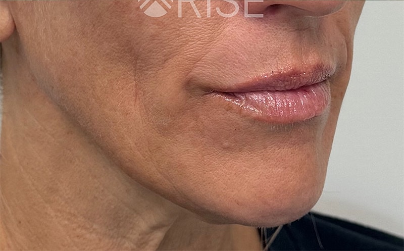 Sculptra Before & After