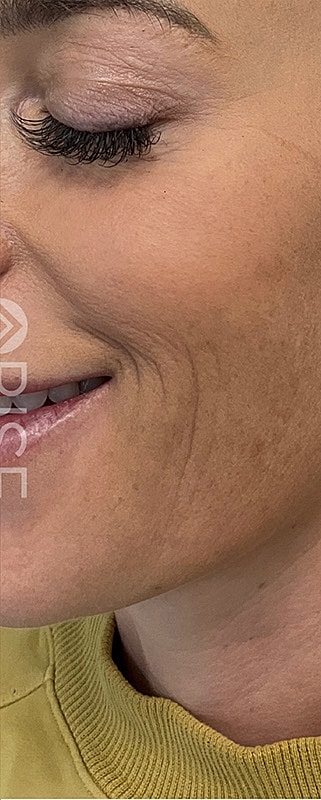 Sculptra Before & After