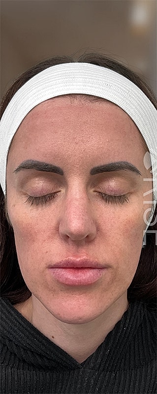 Sculptra Before & After