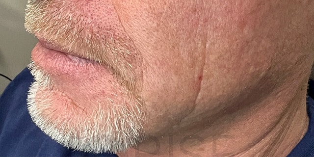 Dermal Fillers Before & After