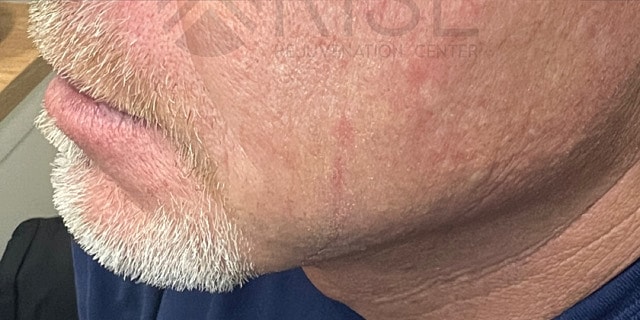 Dermal Fillers Before & After