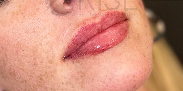 Dermal Fillers Before & After