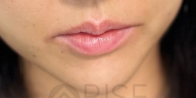 Dermal Fillers Before & After