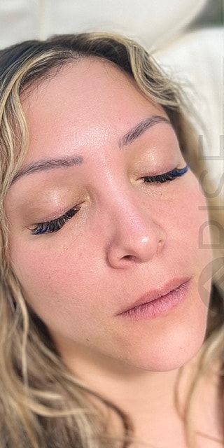 Dermal Fillers Before & After