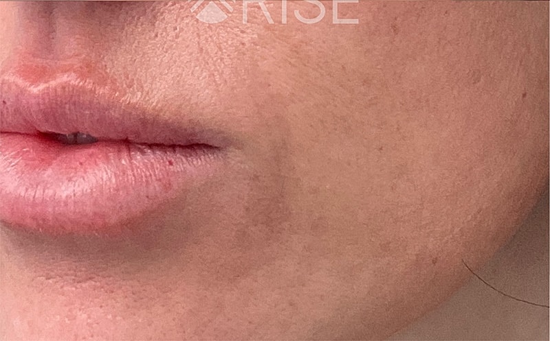 Dermal Fillers Before & After