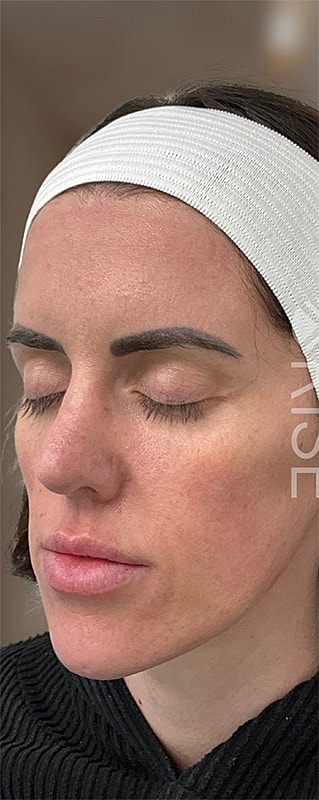 Dermal Fillers Before & After