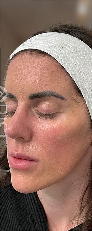 Dermal Fillers Before & After