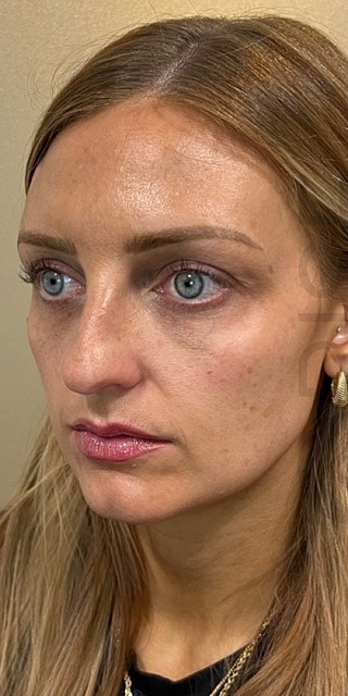 Bio Gel Before & After