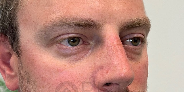 Bio Gel Before & After