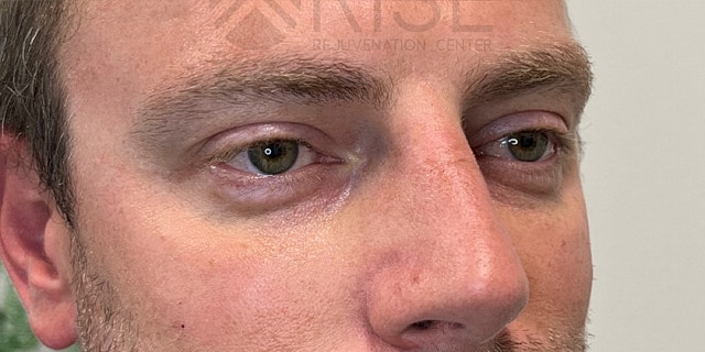 Bio Gel Before & After