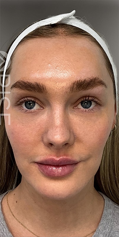 Bio Gel Before & After