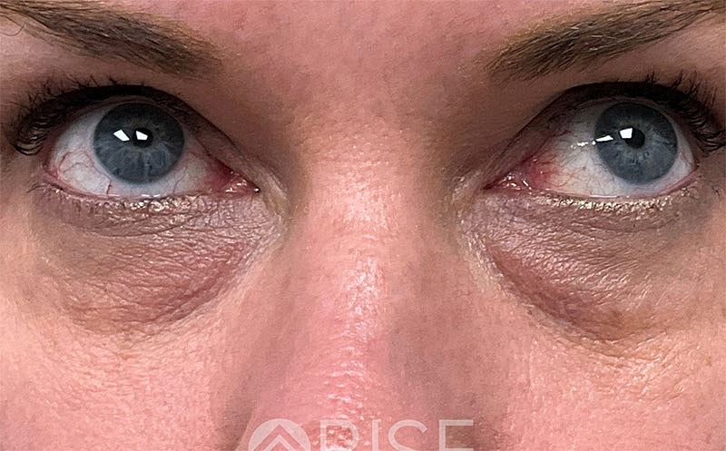 Bio Gel Before & After