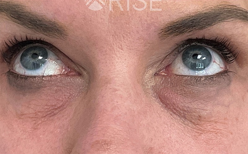 Bio Gel Before & After