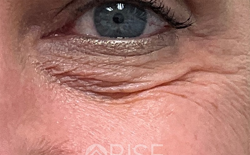 Bio Gel Before & After