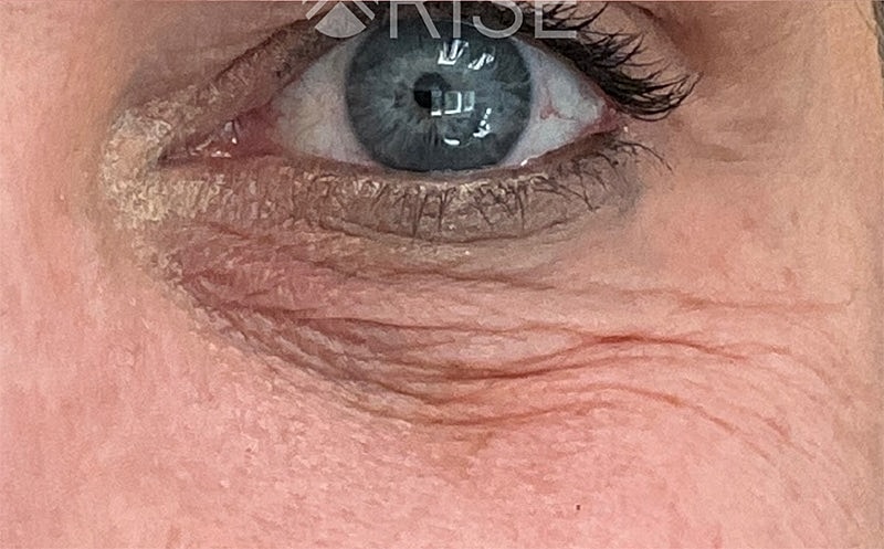 Bio Gel Before & After