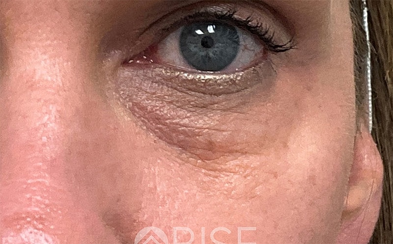 Bio Gel Before & After