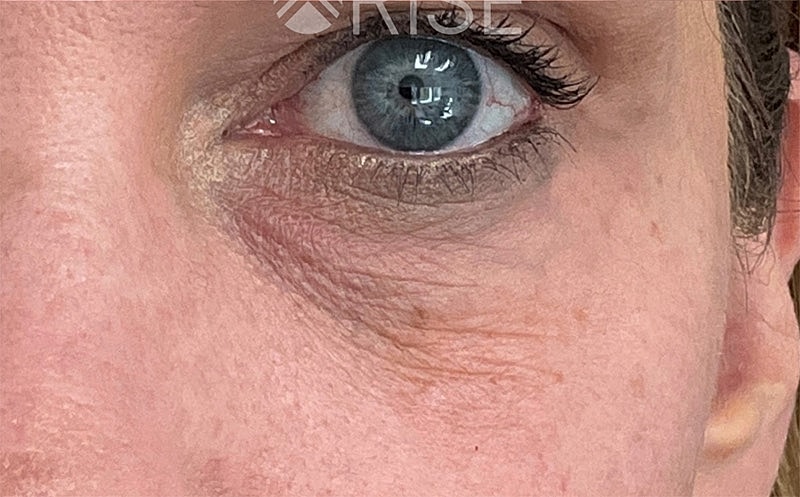 Bio Gel Before & After