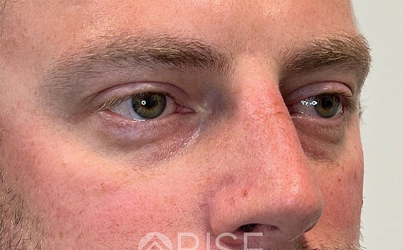 Bio Gel Before & After