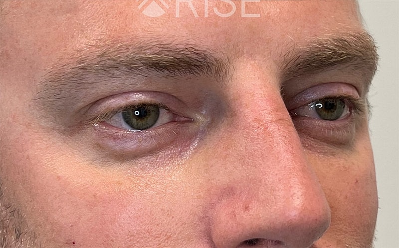 Bio Gel Before & After