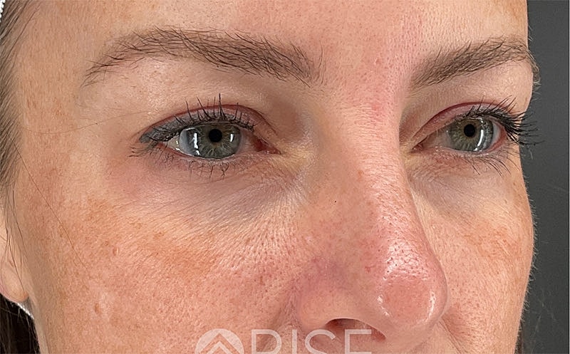 Under Eye Filler Before & After