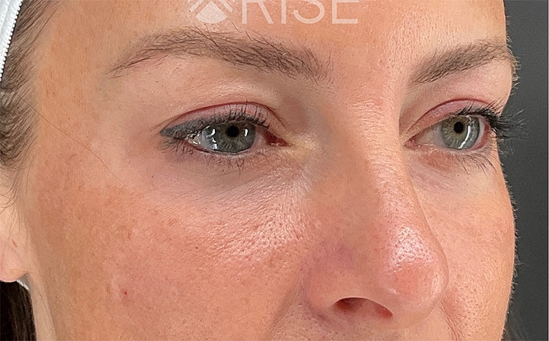Under Eye Filler Before & After