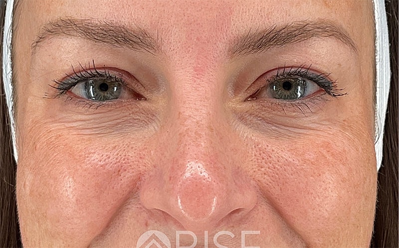 Under Eye Filler Before & After