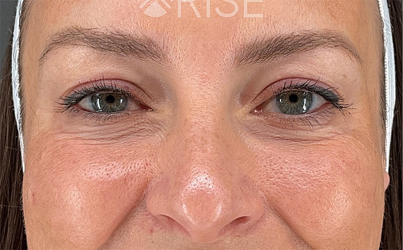 Under Eye Filler Before & After