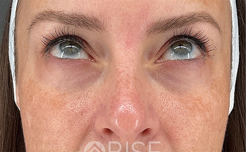 Under Eye Filler Before & After
