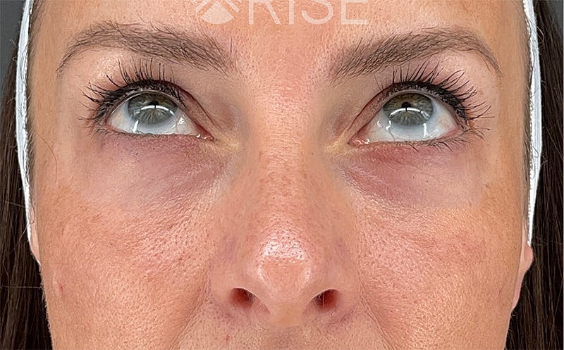 Under Eye Filler Before & After