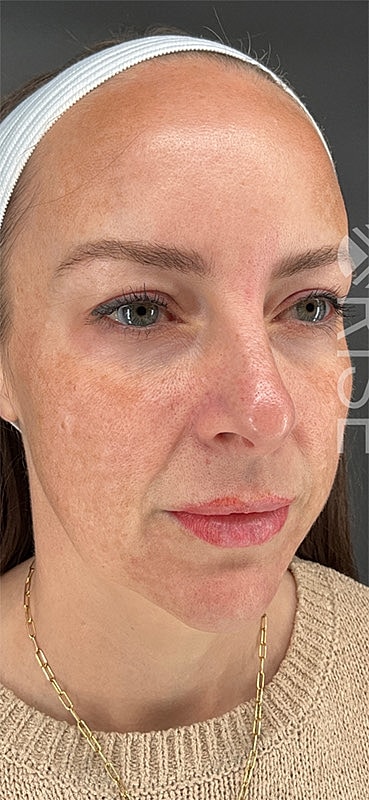 Under Eye Filler Before & After