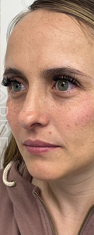 Under Eye Filler Before & After