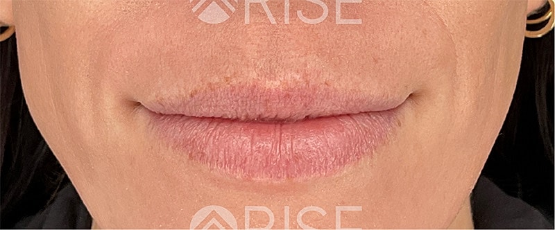 Filler Dissolving Before & After