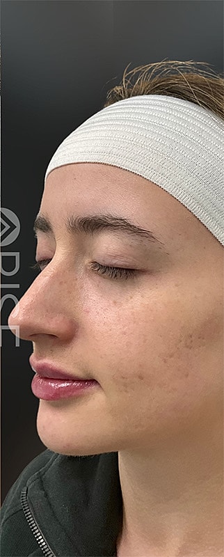 Chin Filler Before & After