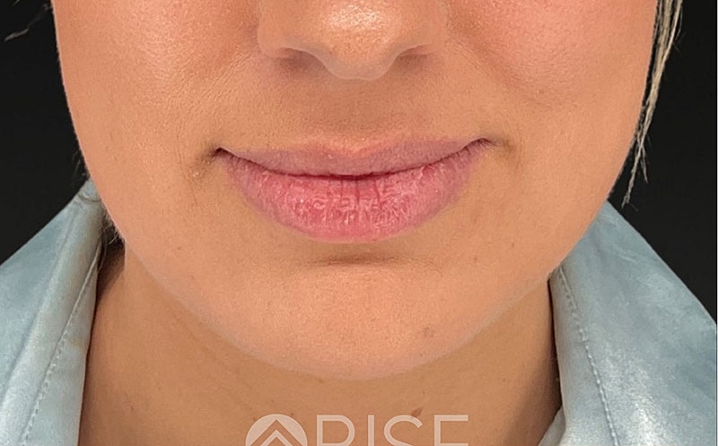 Chin Filler Before & After