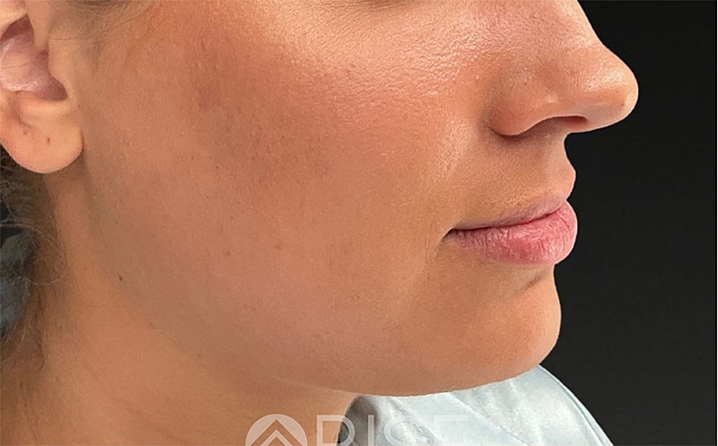Chin Filler Before & After