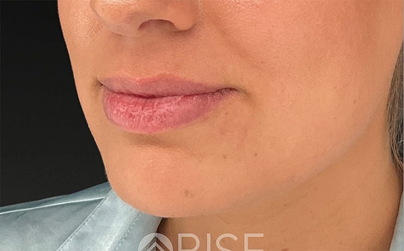 Chin Filler Before & After