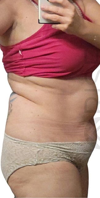 Weight Loss Program With Semaglutide Before & After