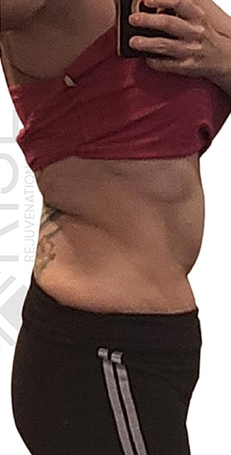 Weight Loss Program With Semaglutide Before & After