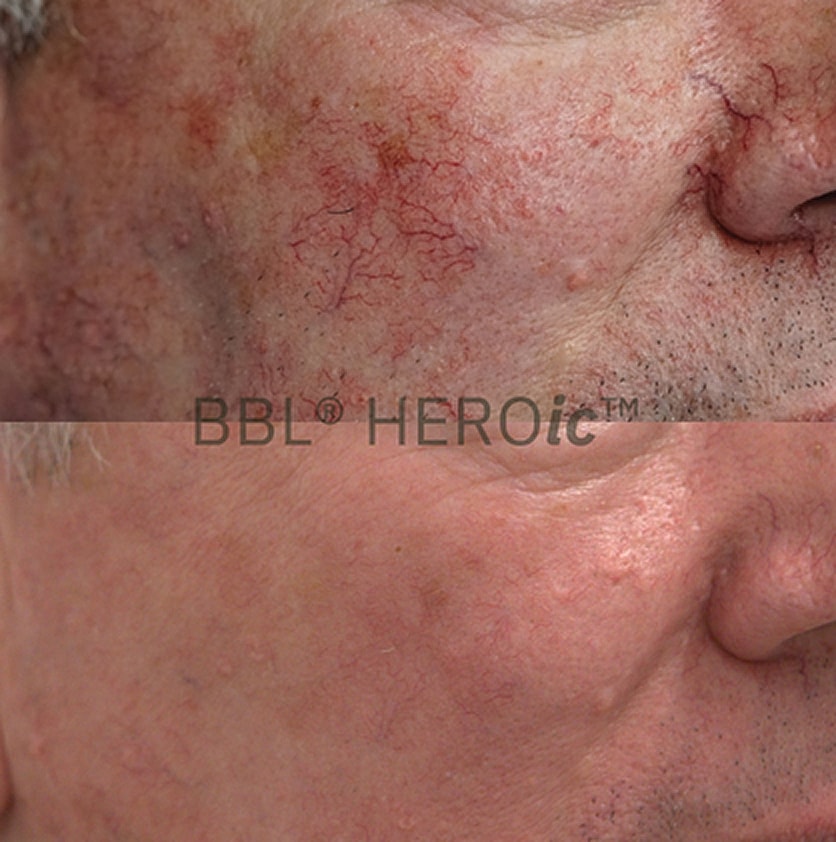 Before and after skin treatment comparison.
