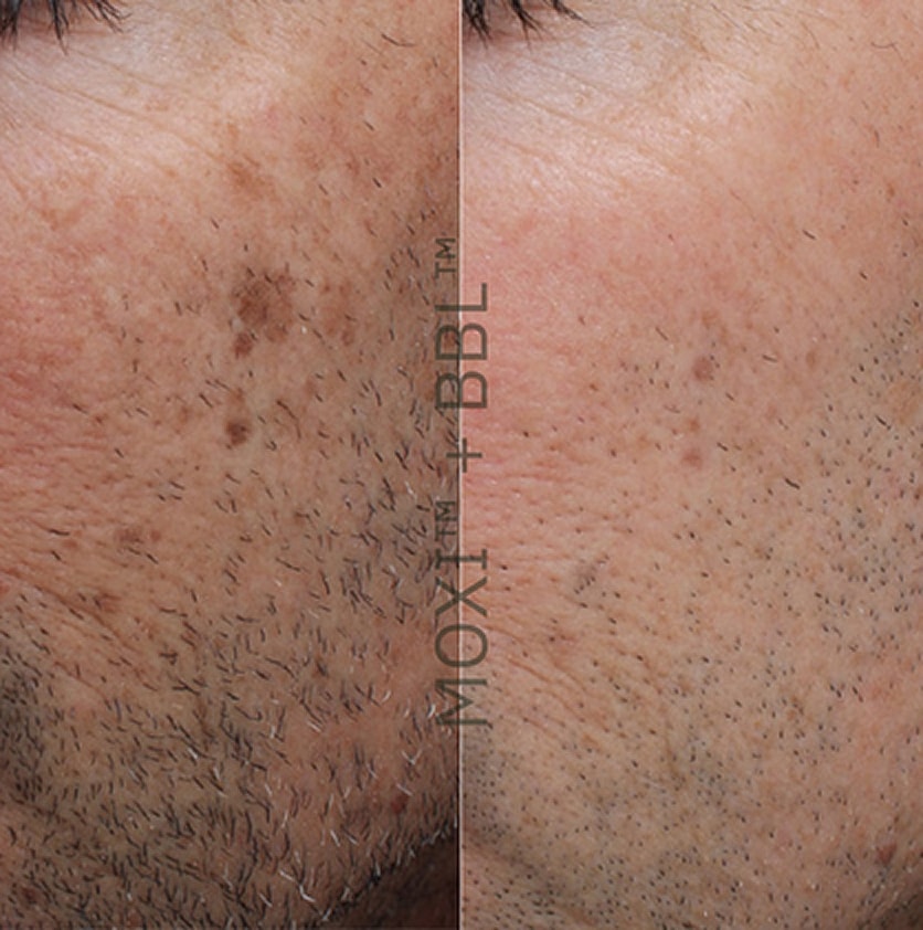 Skin treatment results comparison before and after.