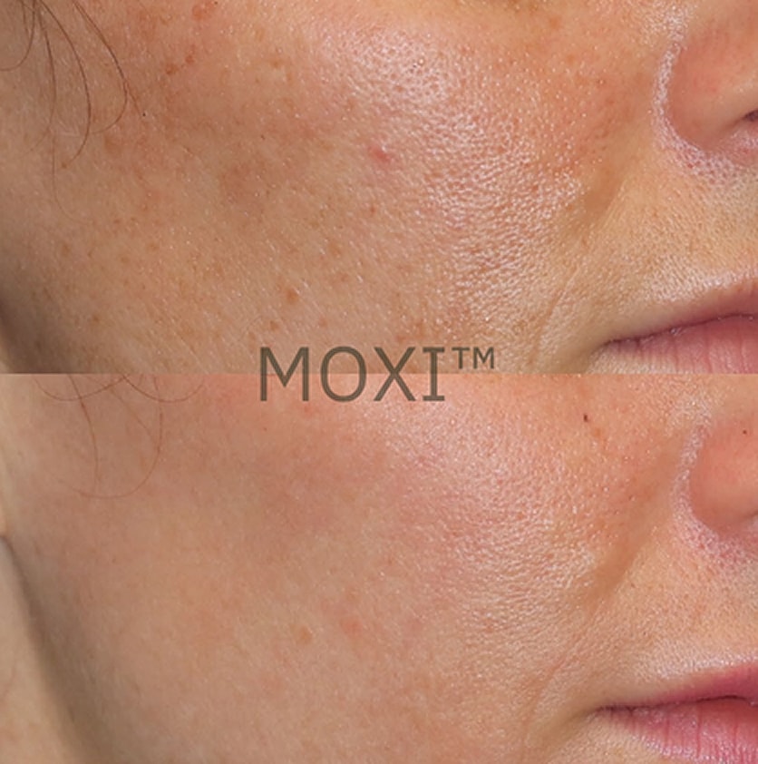 Before and after skin treatment comparison.